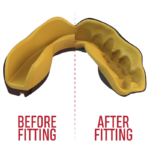 Grafische weergave van de fitting van een gele SafeJawz mondbeschermer, voor en na het passen.