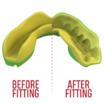 Procesweergave van een gele SafeJawz mondbeschermer, voor en na het aanpassen aan de tanden.