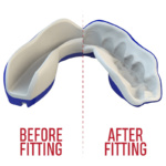 Demonstratie van voor en na het passen van een mondbeschermer, met een duidelijke aanpassing aan de vorm van de tanden.