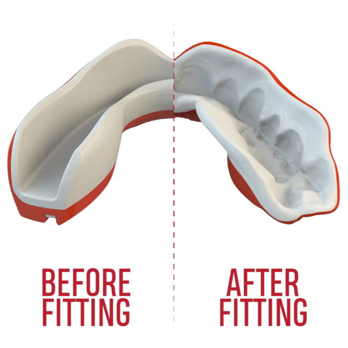 Het proces van vormen aan de tanden voor een aangepaste en veilige pasvorm van de mondbeschermer.
