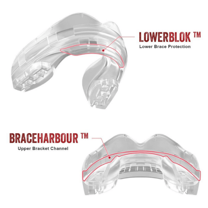 Grafische uitleg van de orthodontische SafeJawz mondbeschermer met LOWERBLOK™ en BRACEHARBOUR™ technologieën voor beugelbescherming.